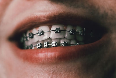 Close-up of man face with braces