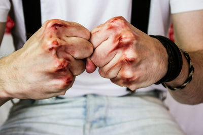 Cropped image of bruised hands of man