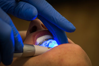 Close-up of dentist's hands