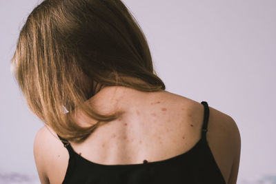 Rear view of woman with spots on back against white background