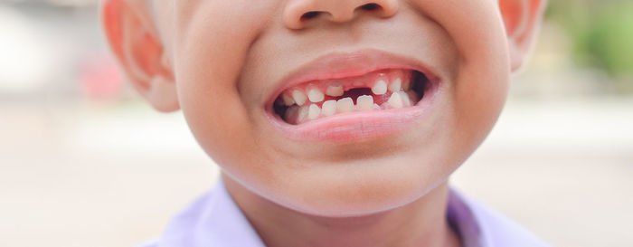 Close-up of boy showing broken teeth