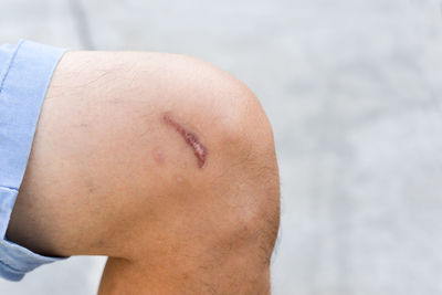 Cropped image of man with wound