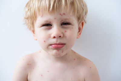 Chickenpox disease, portrait of blonde little boy with red rashes chicken pox virus