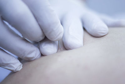 Cropped hands injecting acupuncture needle on patient skin