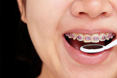 Close-up of braces on woman teeth