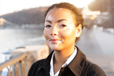 Portrait of young woman with vitiligo standing on footbridge over river