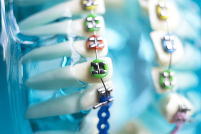 Close-up of human teeth with braces at medical clinic