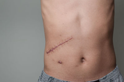 Midsection of shirtless man with wound standing against gray background