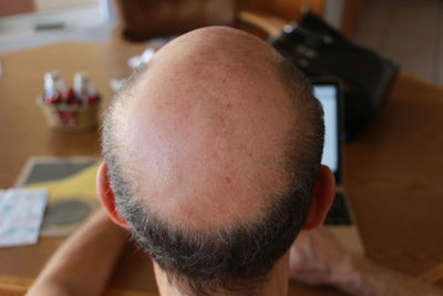 Close-up of man with receding hairline sitting at table