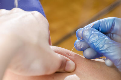 Cropped hand of physiotherapist applying acupuncture needle on skin to patient