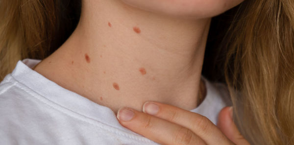 Unrecognizable woman showing her birthmarks on neck skin close up detail of the bare skin sun