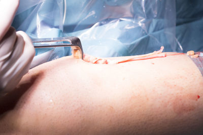 Cropped hands of surgeon performing surgery on patient