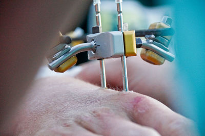 Cropped image of surgeon operating patient with medial equipment