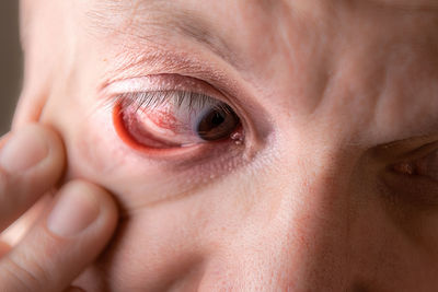 Subconjunctival hemorrhage - hyposphagma. close up of man's face showing red bloodshot eye.