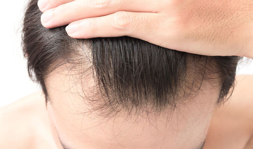 Cropped image of man showing balding hair