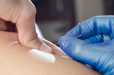 Cropped hand of physiotherapist applying acupuncture needle on skin to patient