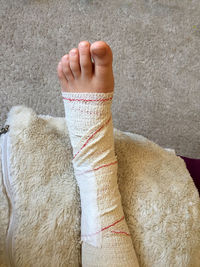 Low section of person with fractured leg