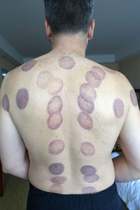 Rear view of shirtless man with vacuum cupping scars