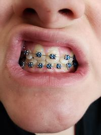 Close-up of man with braces