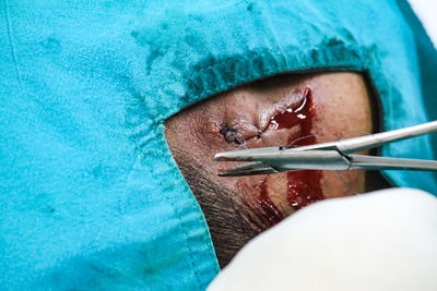 Close-up of person getting surgery