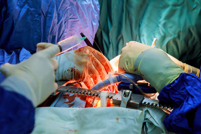 Cropped image of surgeons performing surgery