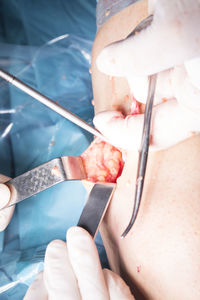 Cropped hands of surgeons doing patient surgery in hospital