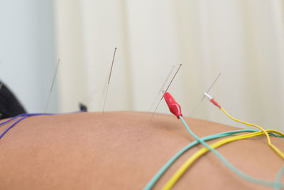 Shirtless man receiving acupuncture treatment