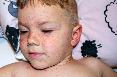 Varicella virus or chickenpox bubble rash on child