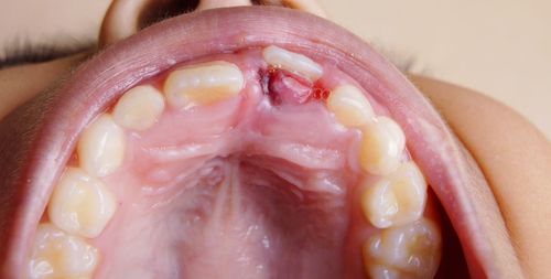 Close-up of boy showing broken teeth