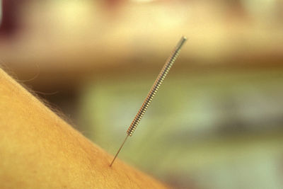 Close-up of acupuncture needle on hand