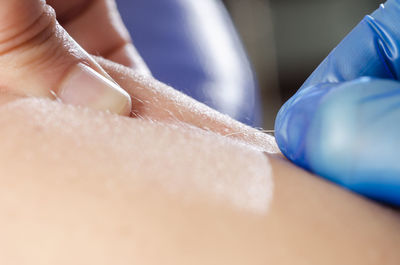 Cropped hand of physiotherapist applying acupuncture needle on skin to patient