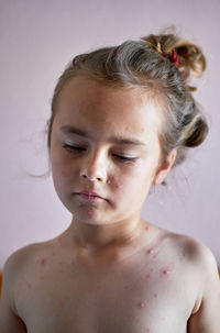 Sad shirtless girl with chickenpox