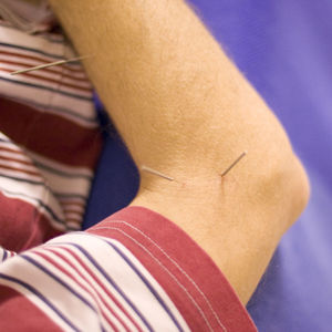 Acupuncture treatment