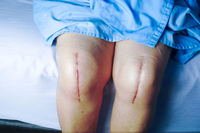 Close-up of wounds on legs