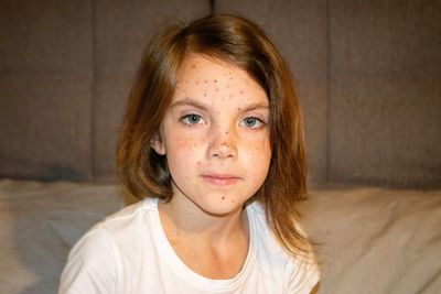 Varicella virus or chickenpox bubble rash on child