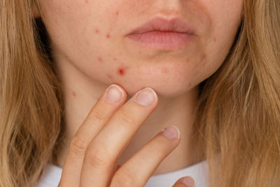 Unrecognizable woman showing her acne on face. close-up acne on woman's face with rash skin ,scar