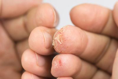 Close-up of bruised fingers