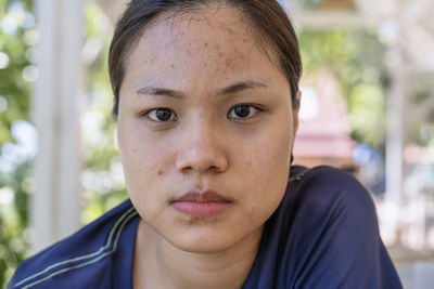 Young asian woman worry about her face when she has problems with skin on her face in a nature.