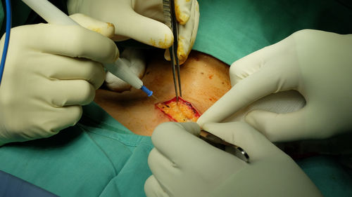 Cropped hands of doctor performing surgery on patient at hospital