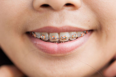 Close-up of young woman with braces