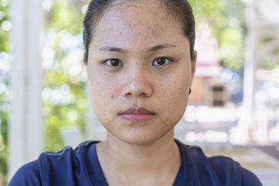 Young asian woman worry about her face when she has problems with skin on her face in  a nature.