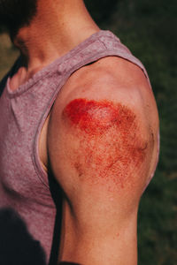 Abrasion on human shoulder after skateboard accident