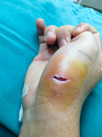 Cropped image of wounded hand
