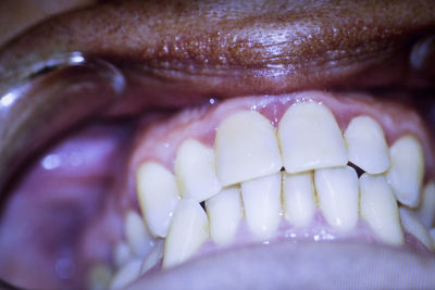 Close-up of person teeth