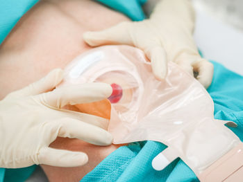 A patient in pajamas with an open abdomen, protruding intestine with a colostomy bag.