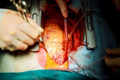 Cropped image of surgeons performing surgery