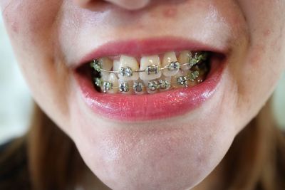 Close-up of woman showing braces