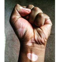 Close-up of clenched fist affected by vitiligo