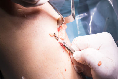 Cropped hands of surgeon performing surgery on patient