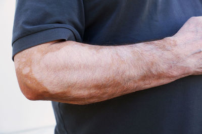 Close-up of mans hand affected by vitiligo against white background